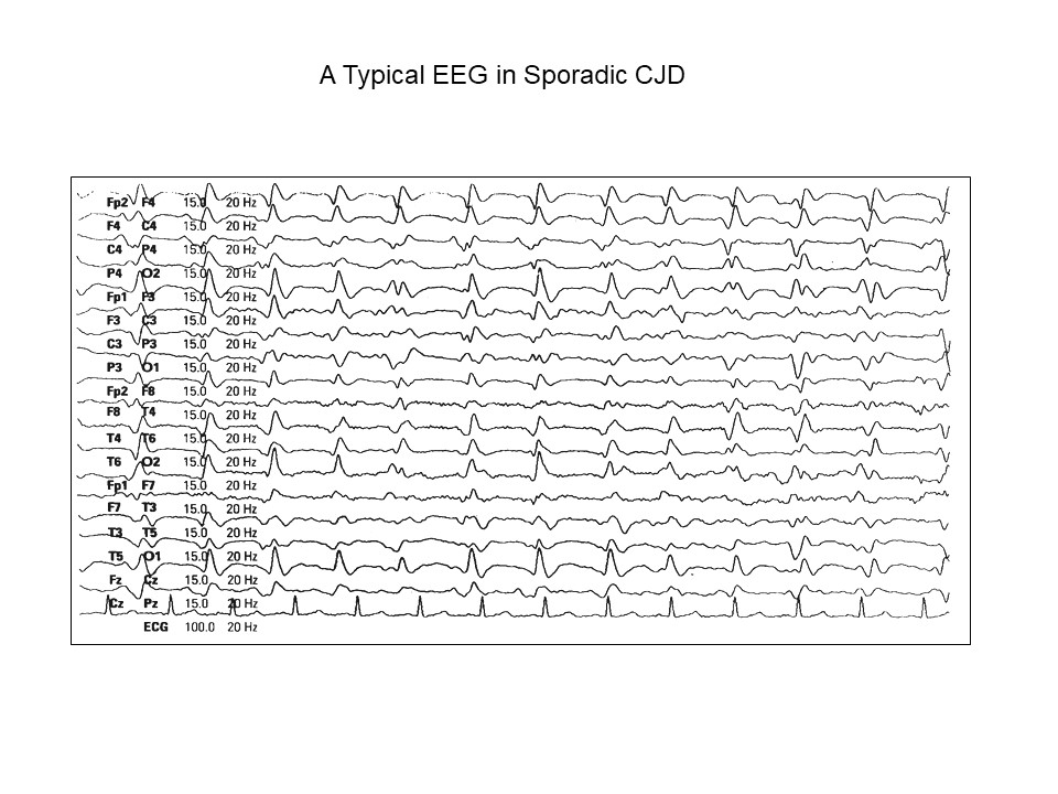 Typical EEG in Sporadic CJD CreutzfeldtJakob Disease International